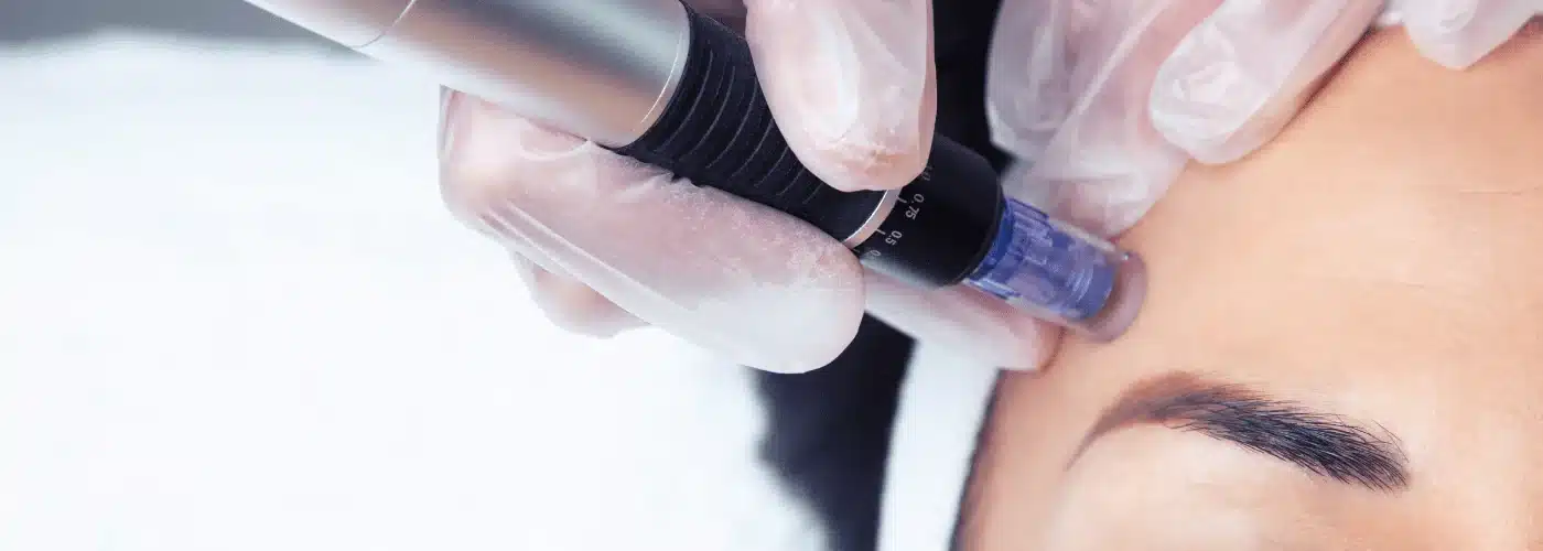 Microneedling in a women's face